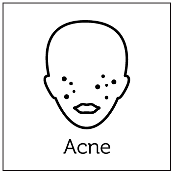 Aerolase Laser Treatments 4 Acne