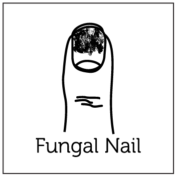 Aerolase Laser Treatments 8 Fungal Nail