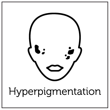 Aerolase Laser Treatments 7 Hyperpigmentation