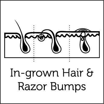 Aerolase Laser Treatments 11 Ingrown Hair