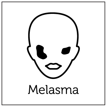 Aerolase Laser Treatments 6 Melasma