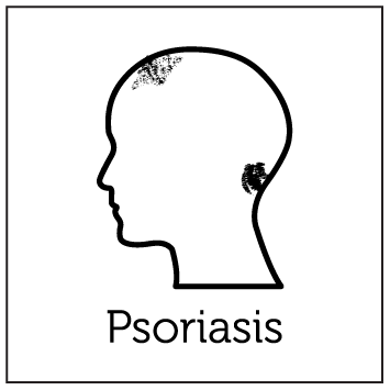 Aerolase Laser Treatments 9 Psoriasis