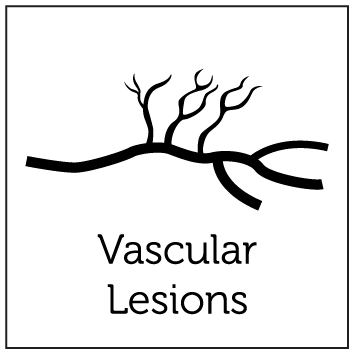Aerolase Laser Treatments 5 Vascular Lesions