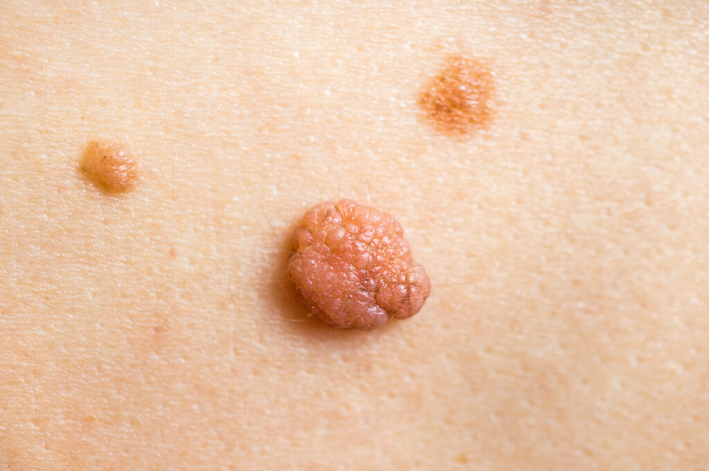 Moles, Skin Tags, and Cysts: Spot the Differences and Know Your Next Steps 2 shutterstock 1129839818 scaled
