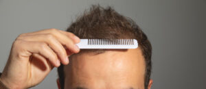 First Clinic in UK to offer Autologous Exosomes for Hair Loss