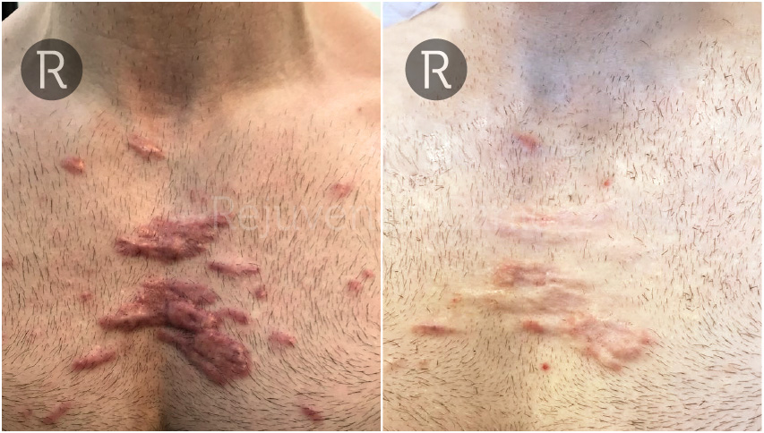 Chest Keloid