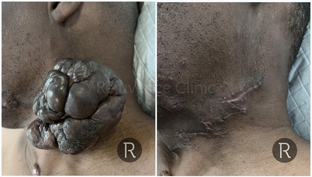 Neck Keloid