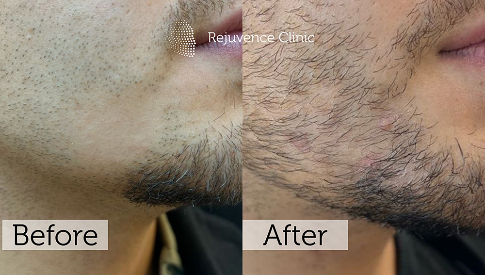 Alopecia Areata Treatment in London | Rejuvence Clinic 33 11