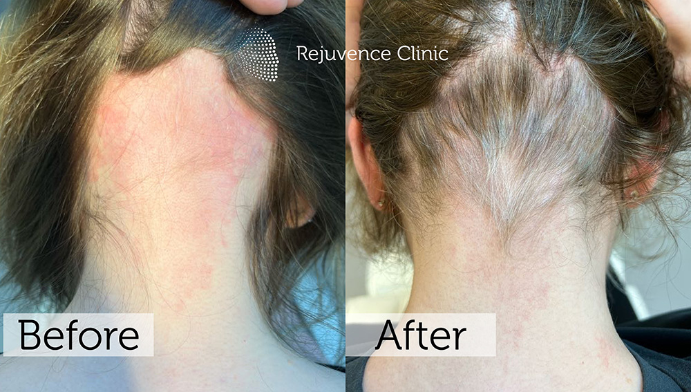 Alopecia Areata Treatment in London | Rejuvence Clinic 14 12