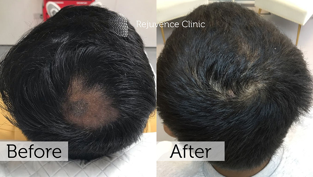 Alopecia Areata Treatment in London | Rejuvence Clinic 16 14