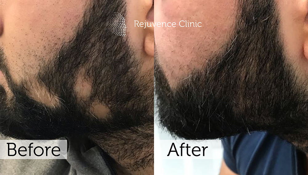 Alopecia Areata Treatment in London | Rejuvence Clinic 34 15