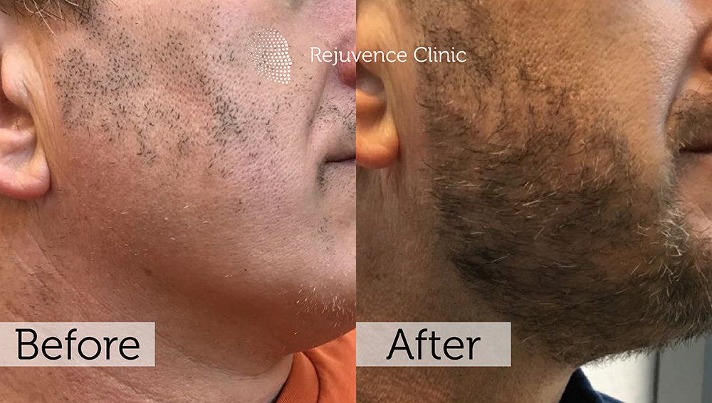 Alopecia Areata Treatment in London | Rejuvence Clinic 36 16