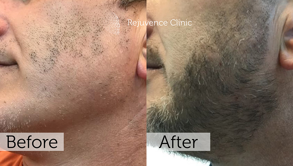 Alopecia Areata Treatment in London | Rejuvence Clinic 37 17