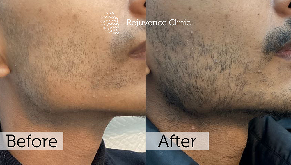 Alopecia Areata Treatment in London | Rejuvence Clinic 38 18