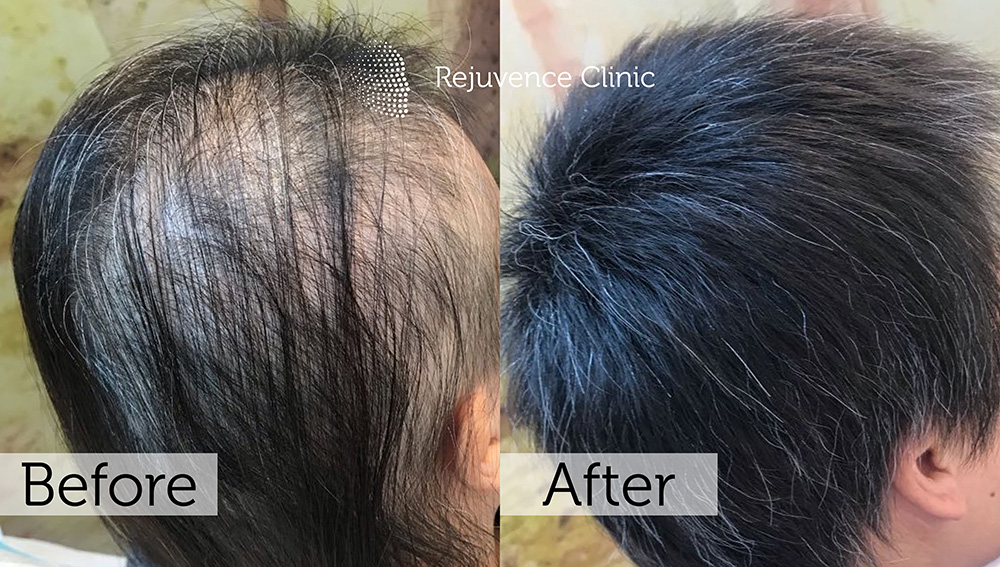 Alopecia Areata Treatment in London | Rejuvence Clinic 17 19