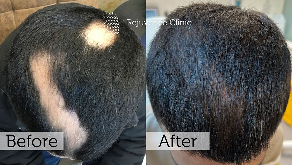 Alopecia Areata Treatment in London | Rejuvence Clinic 18 20