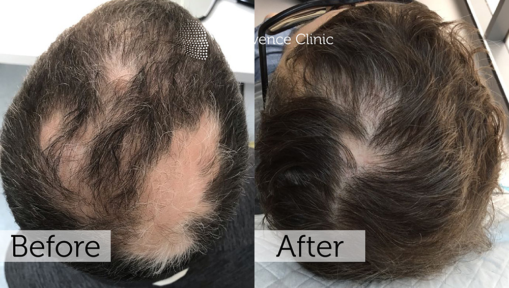 Alopecia Areata Treatment in London | Rejuvence Clinic 19 21