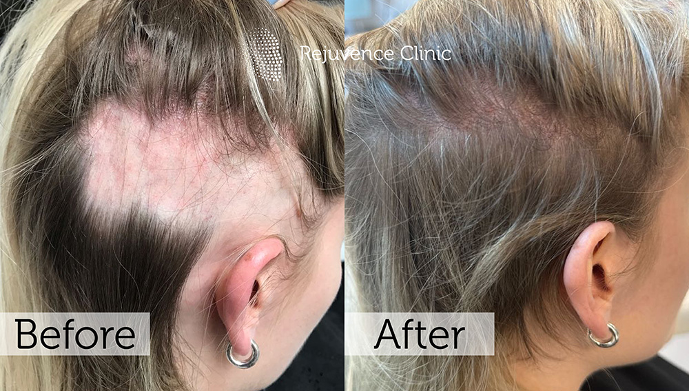 Alopecia Areata Treatment in London | Rejuvence Clinic 20 22