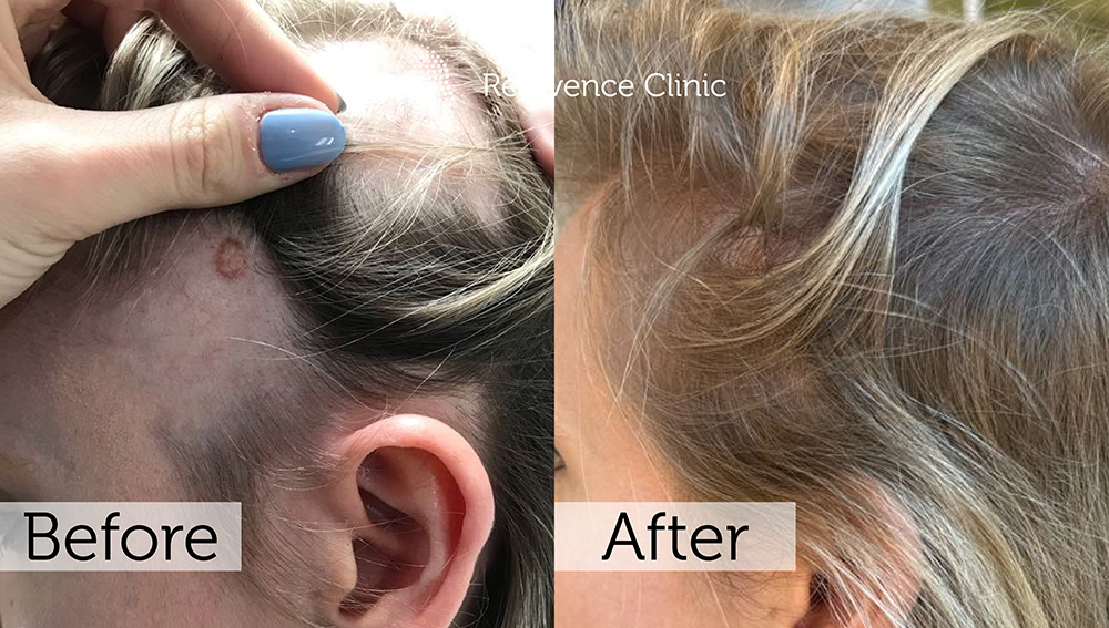 Alopecia Areata Treatment in London | Rejuvence Clinic 21 23