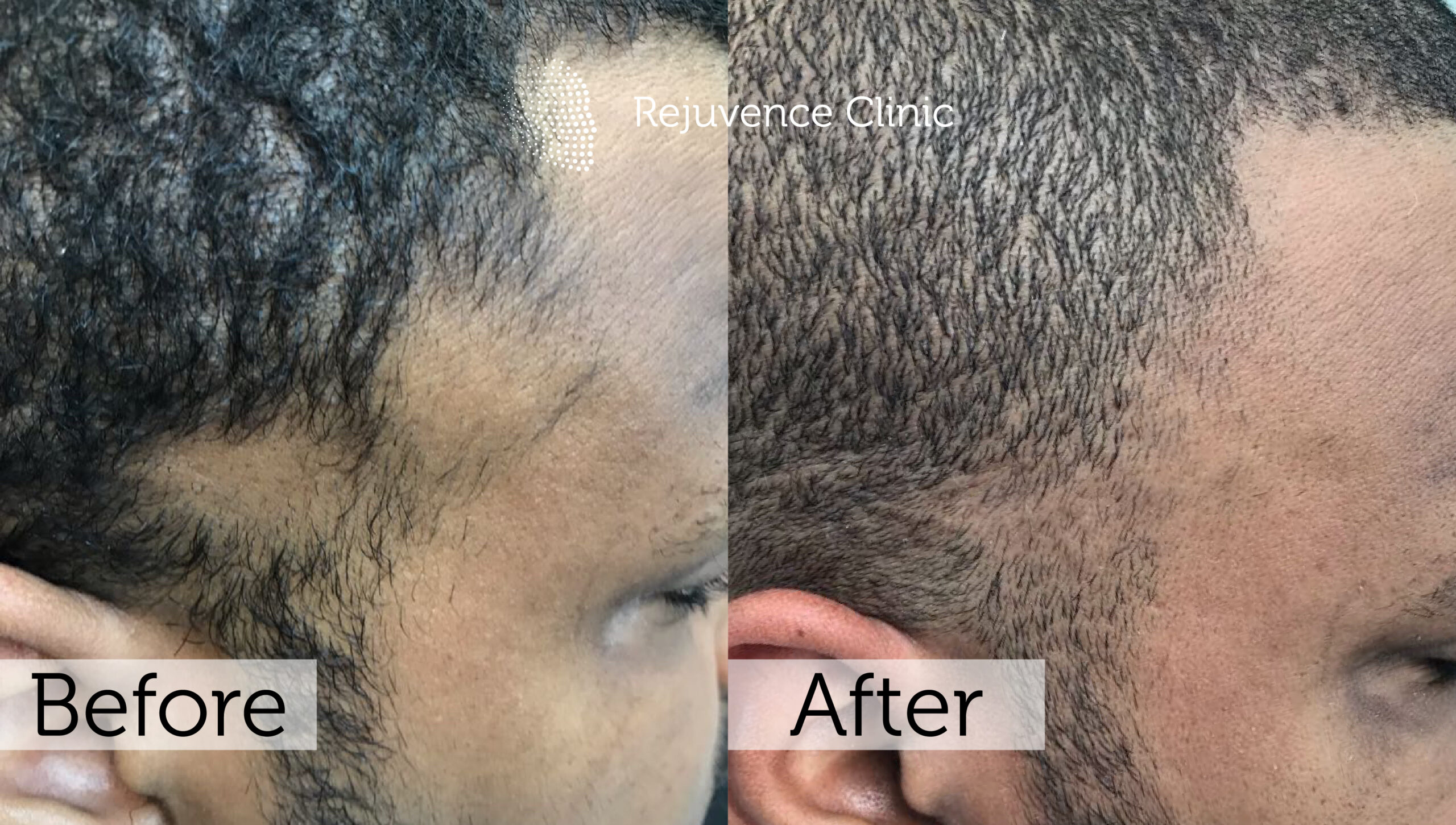 Alopecia Areata Treatment in London | Rejuvence Clinic 22 24