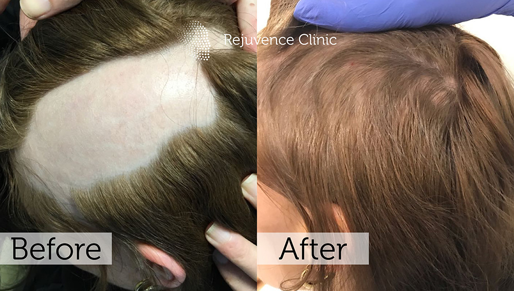 Alopecia Areata Treatment in London | Rejuvence Clinic 23 25