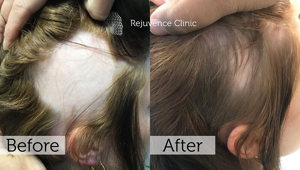 Alopecia Areata Treatment in London | Rejuvence Clinic 24 26