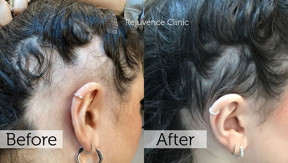 Alopecia Areata Treatment in London | Rejuvence Clinic 25 27