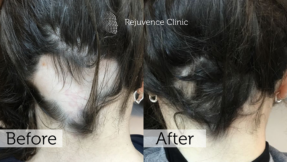 Alopecia Areata Treatment in London | Rejuvence Clinic 26 28