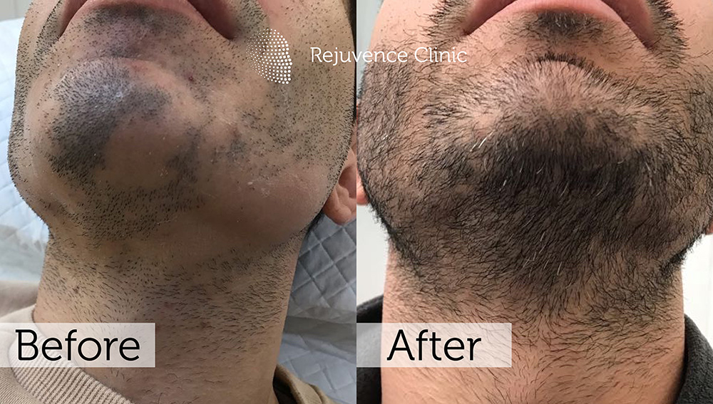 Alopecia Areata Treatment in London | Rejuvence Clinic 40 30