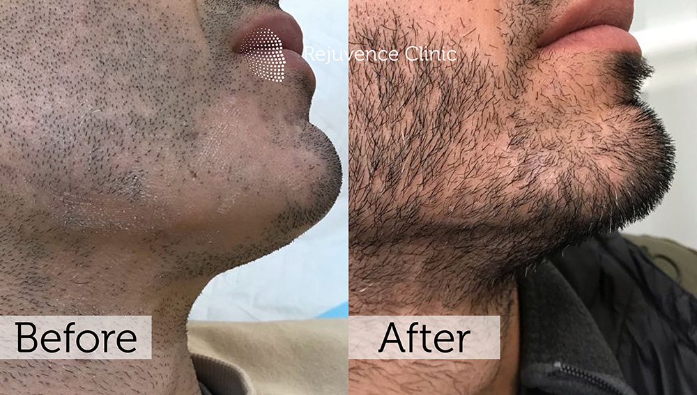 Alopecia Areata Treatment in London | Rejuvence Clinic 41 32