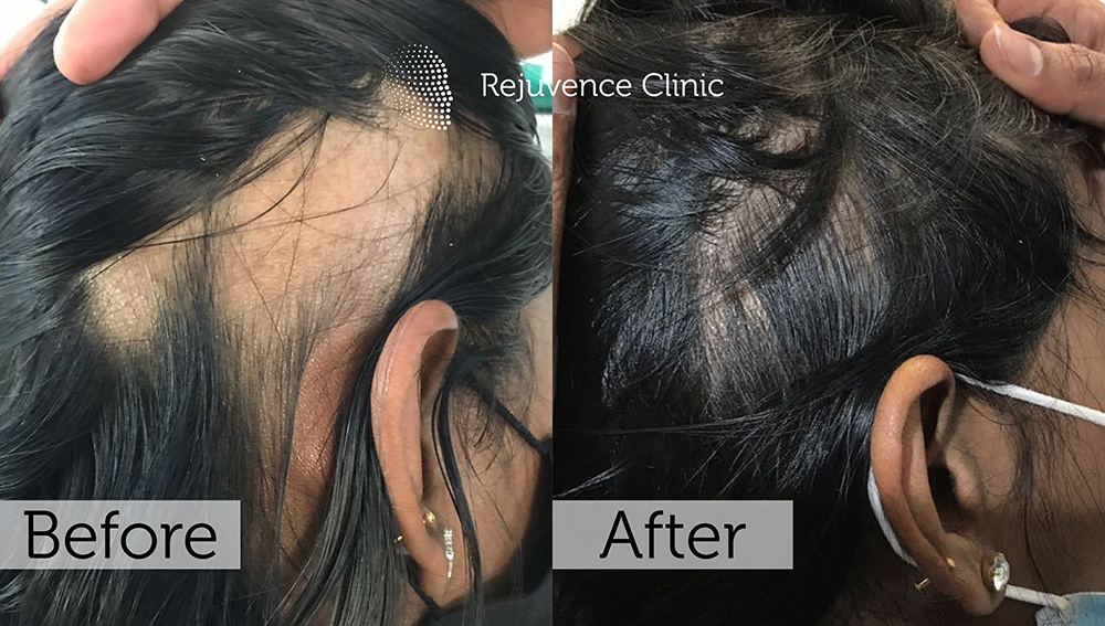Alopecia Areata Treatment in London | Rejuvence Clinic 27 33