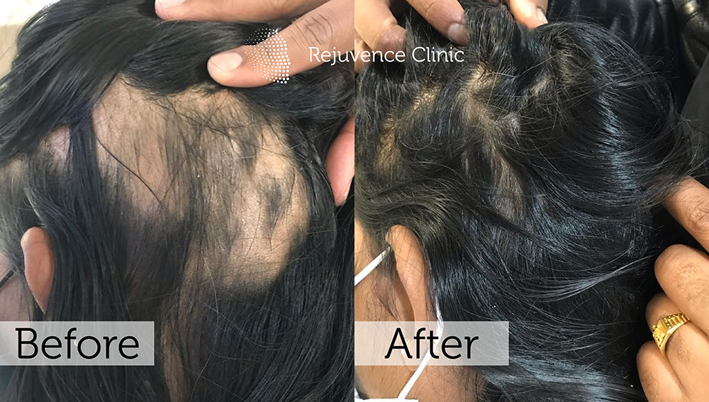 Alopecia Areata Treatment in London | Rejuvence Clinic 32 35