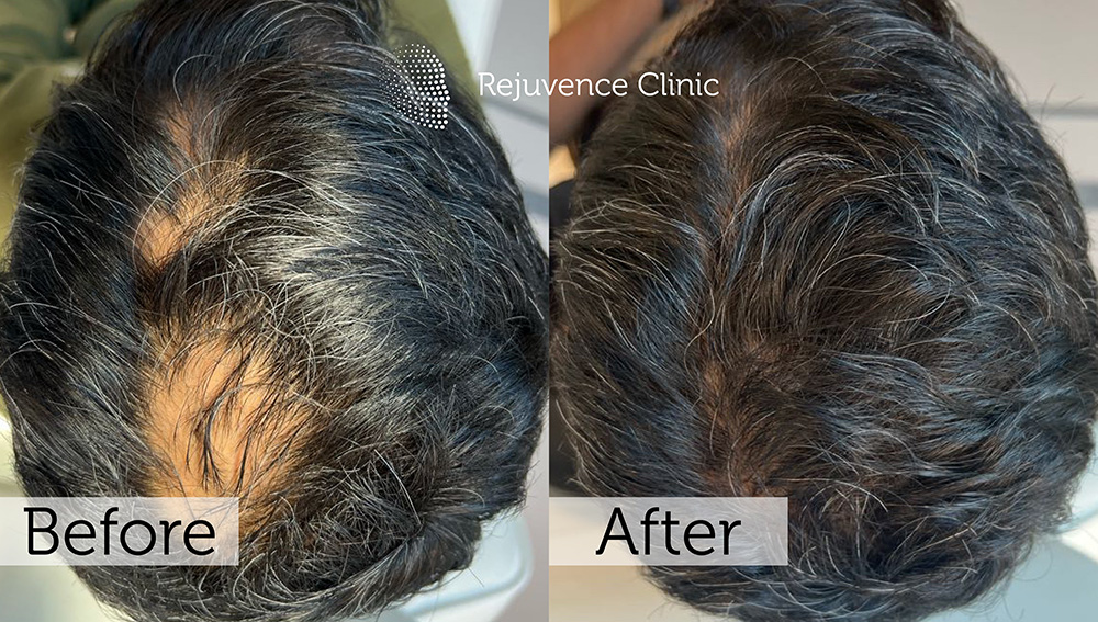 Alopecia Areata Treatment in London | Rejuvence Clinic 28 36