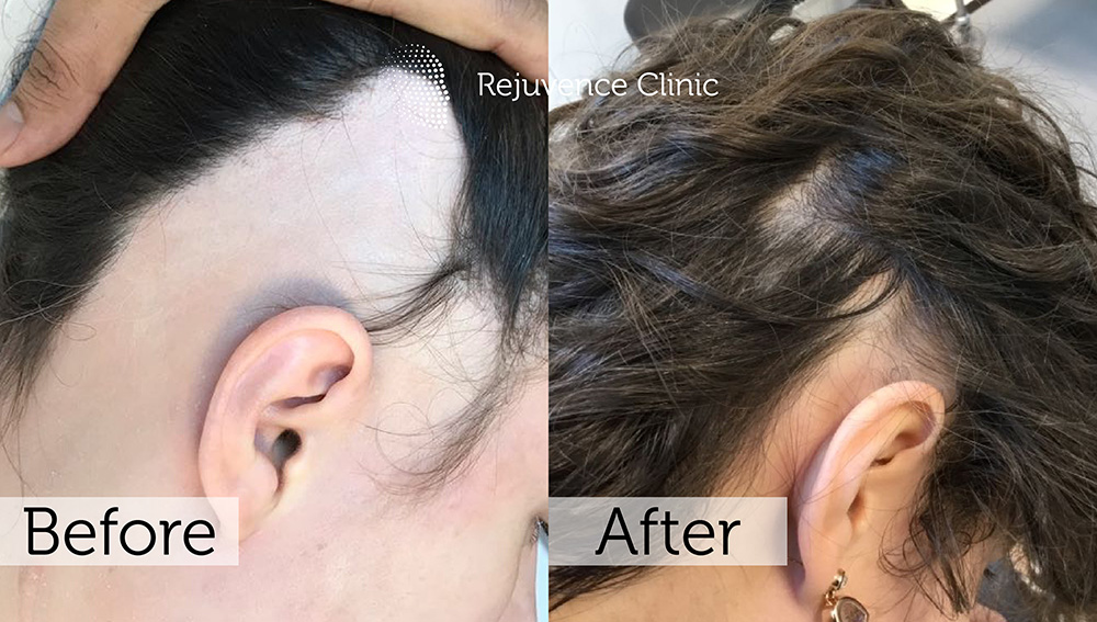 Alopecia Areata Treatment in London | Rejuvence Clinic 29 37