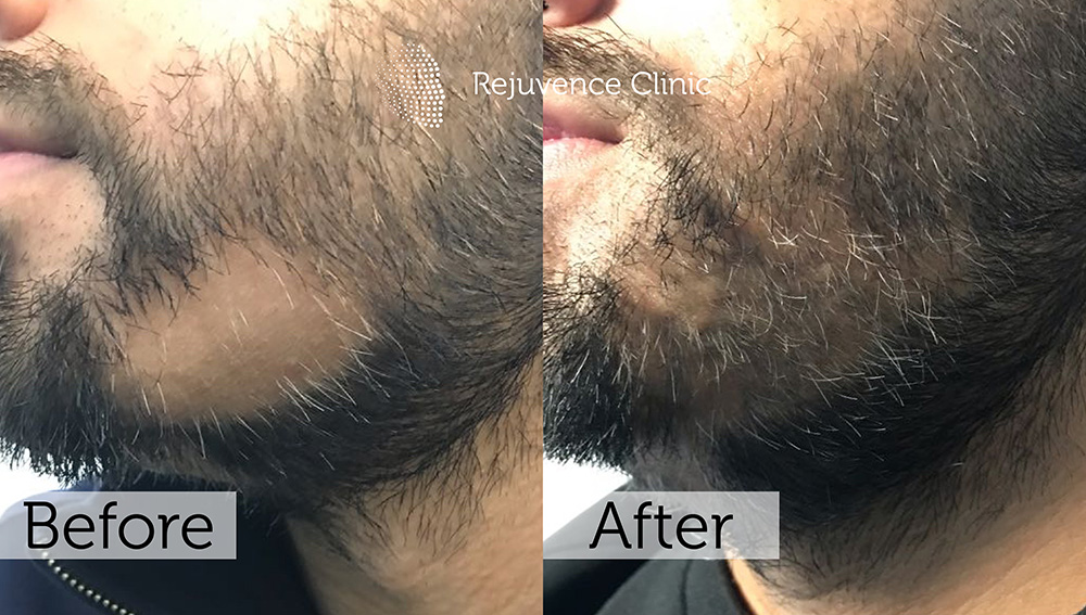 Alopecia Areata Treatment in London | Rejuvence Clinic 42 38
