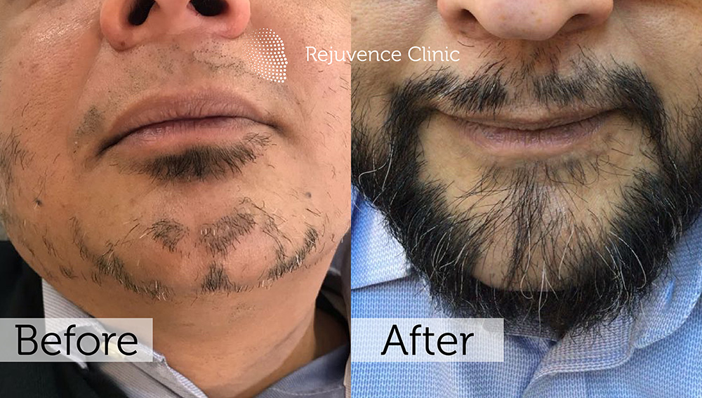 Alopecia Areata Treatment in London | Rejuvence Clinic 35 39