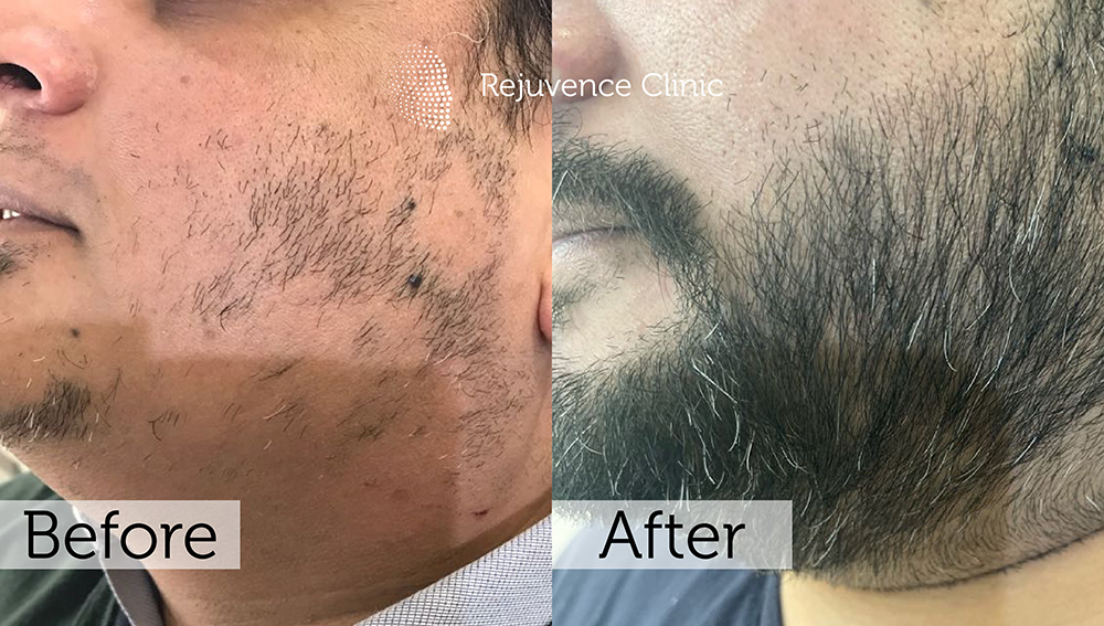 Alopecia Areata Treatment in London | Rejuvence Clinic 43 40