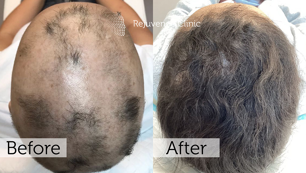 Alopecia Areata Treatment in London | Rejuvence Clinic 30 42