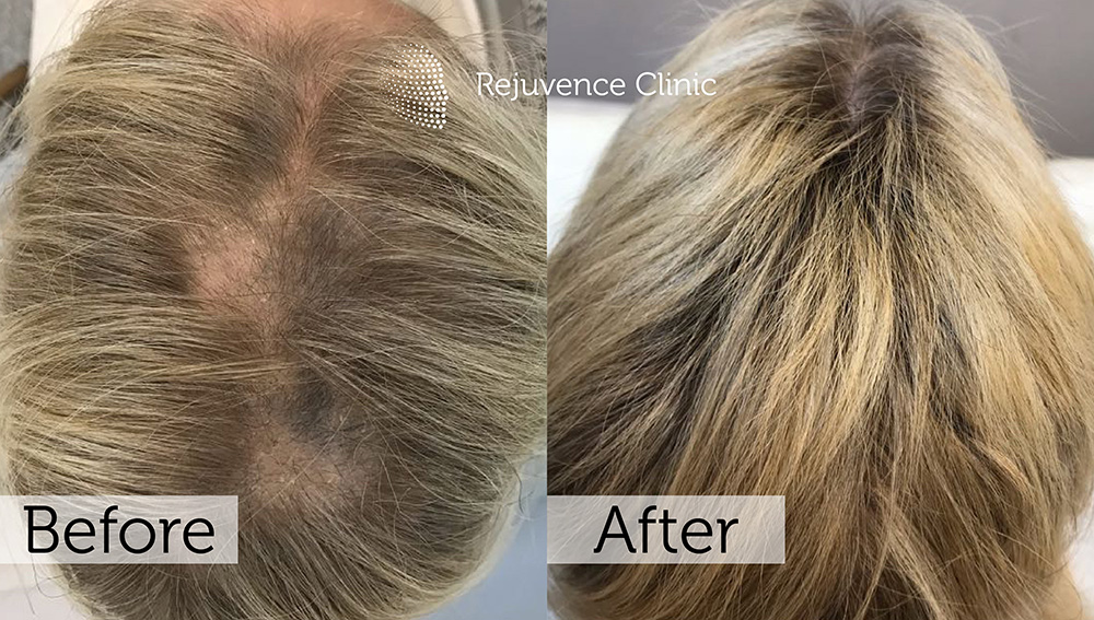 Alopecia Areata Treatment in London | Rejuvence Clinic 31 43