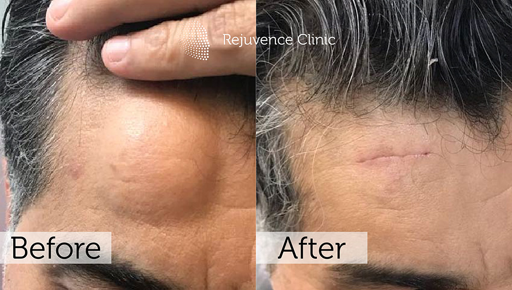 Lipoma Removal London | Rejuvence Clinic 4 1
