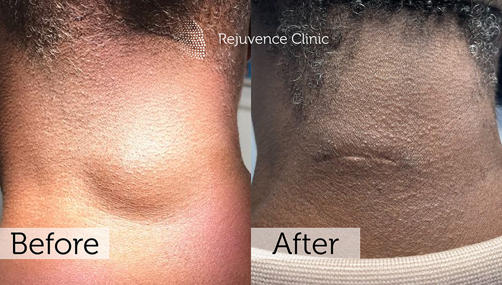 Lipoma Removal London | Rejuvence Clinic 18 11