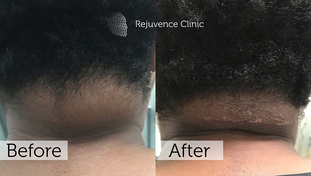 Lipoma Removal London | Rejuvence Clinic 20 12