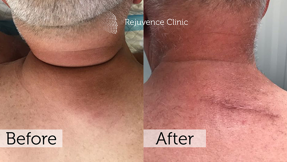 Lipoma Removal London | Rejuvence Clinic 19 13