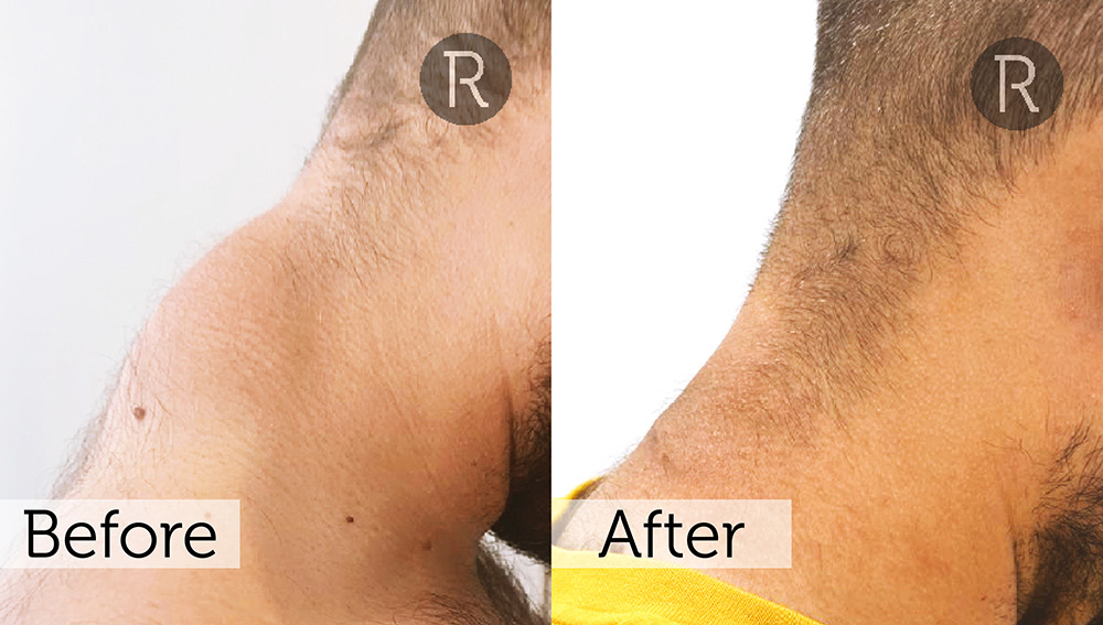 Lipoma Removal London | Rejuvence Clinic 16 14