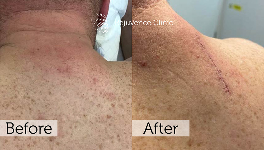 Lipoma Removal London | Rejuvence Clinic 17 15
