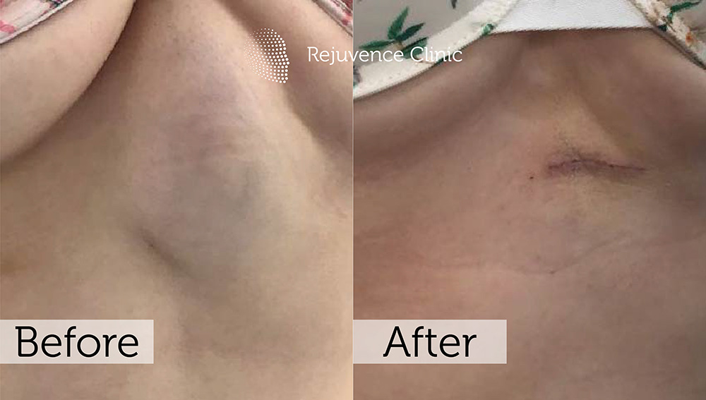 Lipoma Removal London | Rejuvence Clinic 23 16