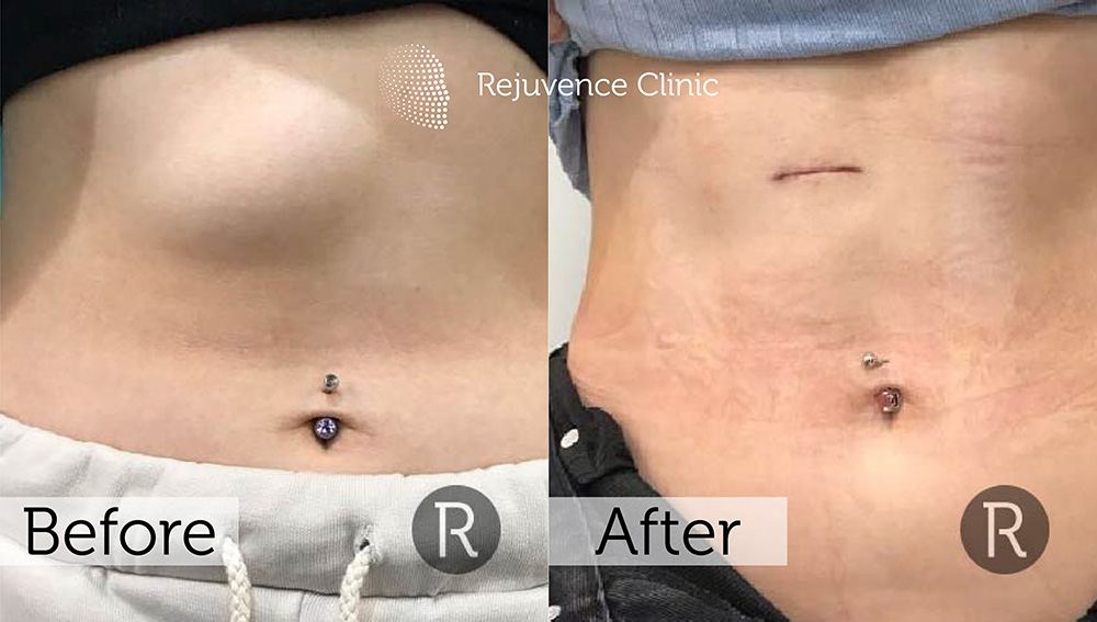 Lipoma Removal London | Rejuvence Clinic 24 17