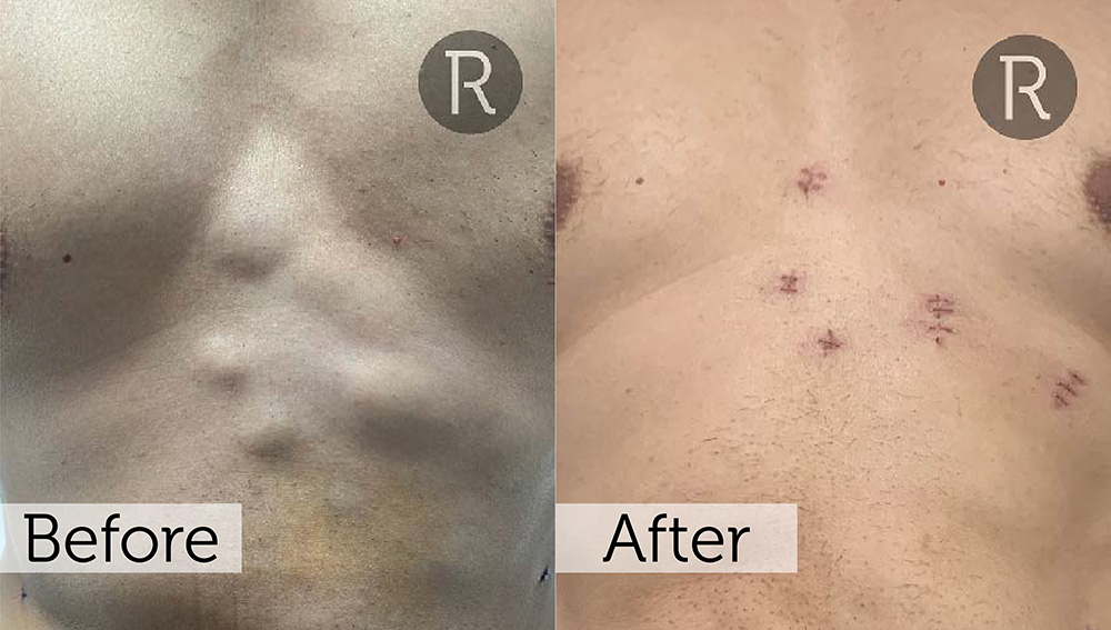 Lipoma Removal London | Rejuvence Clinic 25 18