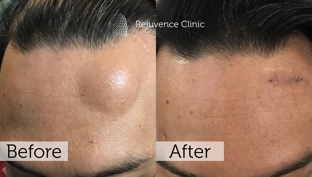 Lipoma Removal London | Rejuvence Clinic 5 2