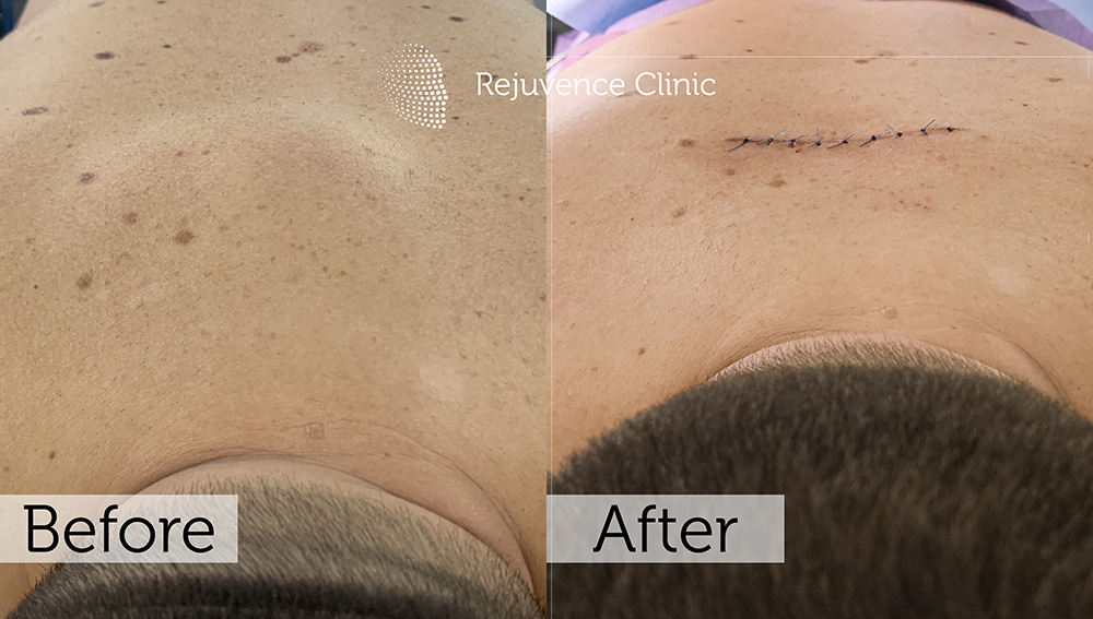 Lipoma Removal London | Rejuvence Clinic 29 20